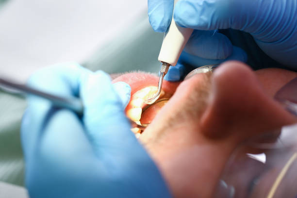 Best Emergency Root Canal Treatment in Nicholson, GA