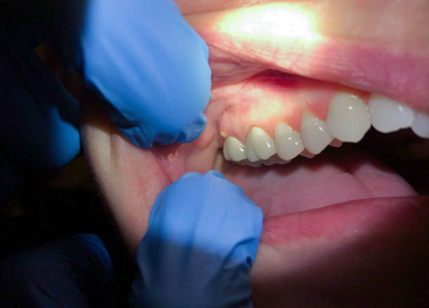 Best Emergency Dentist for Knocked-Out Tooth in Nicholson, GA