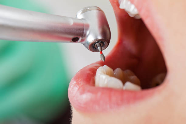 Best Emergency Dentist for Knocked-Out Tooth in Nicholson, GA